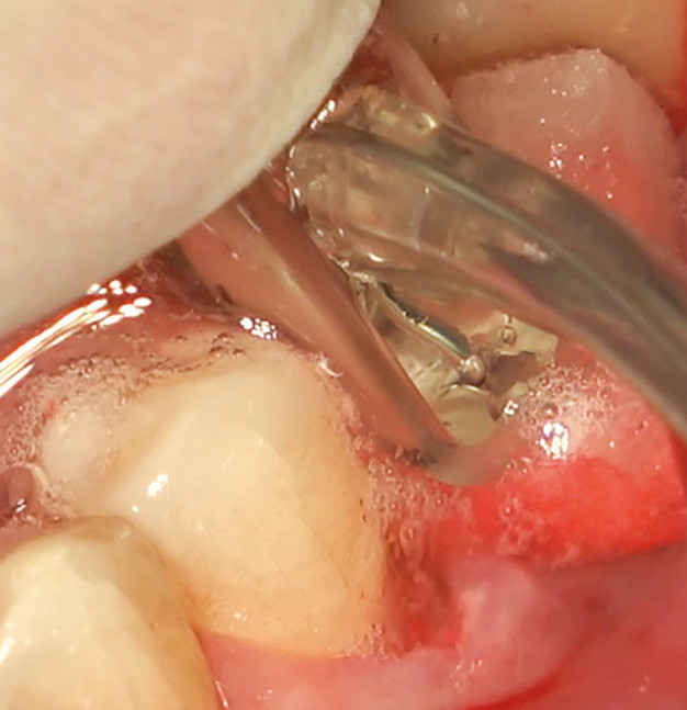 10, 11 et 12. L’étape clé est la décontamination de la surface implantaire. Ici, nous avons choisi d’utiliser le protocole électrolytique Galvosurge. Des bulles d’hydrogène se forment à la surface de l’implant puis se détachent, entraînant avec elles le biofilm. On réalise ainsi une décontamination sans altération structurelle de la surface implantaire et on obtient une surface implantaire prête pour la ré-ostéointégration. Ce système peut être utilisé à chaque fois qu’on peut démonter les éléments prothétiques implantaires. L’avantage est une décontamination efficace et complète de la surface micro-rugueuse exposée [5]. à la fin de cette phase, une vis de couverture est placée sur l’implant afin de pouvoir passer en toute sérénité à l’étape reconstructrice. Le patient prend, à partir de la veille de l’intervention, 500 mg d’amoxicilline/métronidazole 3 x par jour pendant une semaine.