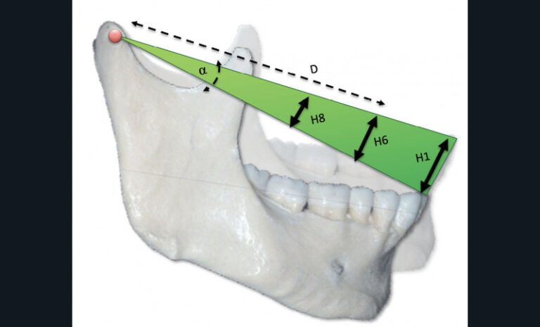 4. Variations de DVO : les condyles sont le centre de rotation. Pour une même variation angulaire de DVO, les variations linéaires induites seront différentes au niveau de l’incisive (H1), de la première molaire (H6) ou de la troisième molaire (H8) (H = α * D).
