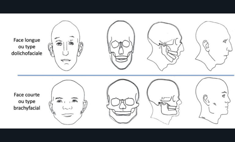 6. Face longue et face courte : déterminées génétiquement, elles peuvent être accentuées par les dysfonctions/parafonctions. D’après Enlow, Dale, (Enlow and Hans, 1996).