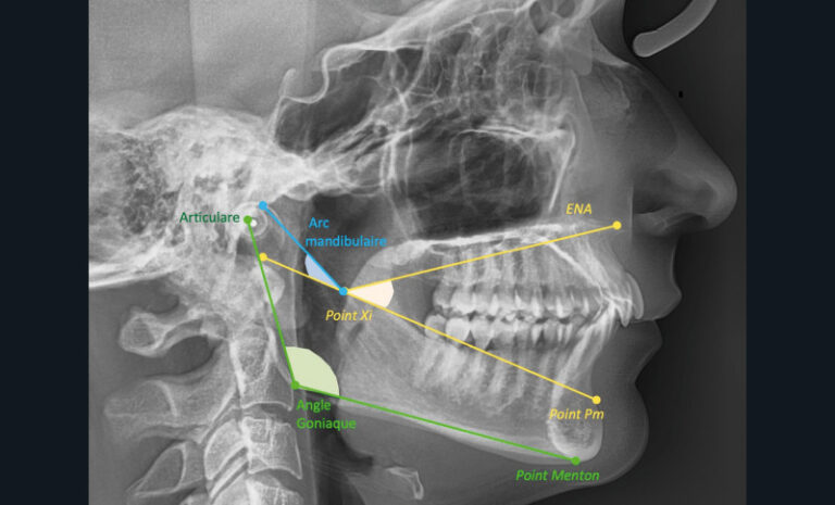 10. Angle de la hauteur faciale inférieure ou DVO (ENA-Xi-Pm).