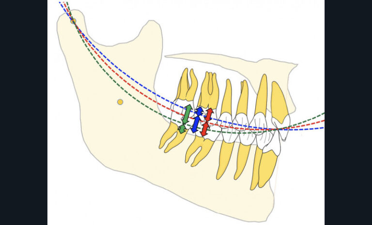 13. DVO et courbe de Spee : suivant le rayon de la courbe de Spee (bleu, rouge, vert), la hauteur verticale sera répartie différemment entre les dents maxillaires et les dents mandibulaires.