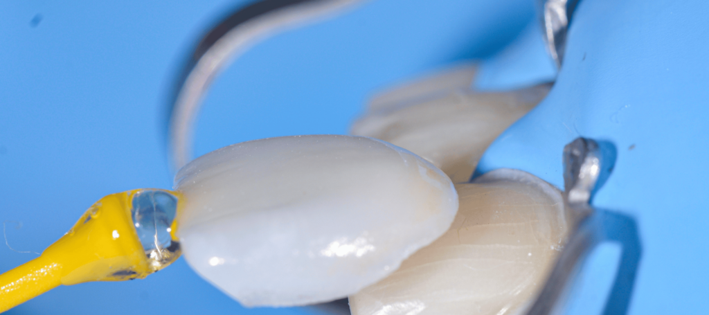 Restaurations adhesives