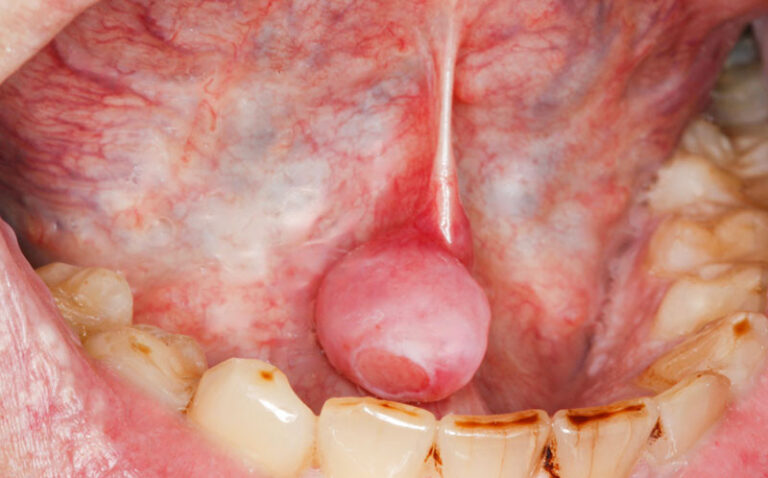 FIBROME SCLEREUX ou COLLAGENOME STORIFORME