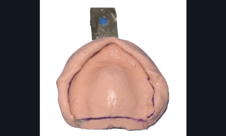 2. Tracé des limites du futur porte-empreinte individuel sur l’empreinte primaire à l’alginate.
