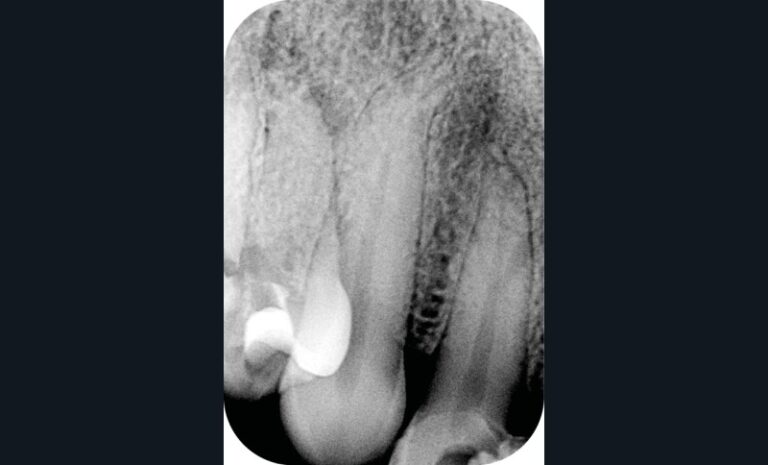 2. Mise en évidence d’un canal latéral présent dans le tiers apical, lors de la réalisation du traitement endodontique. Radiographie pré-opératoire au niveau de 12 (a).