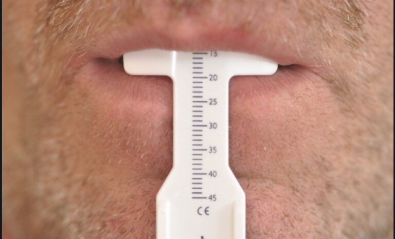 3. Mesure de la lèvre supérieure à l’aide d’un papillomètre. Cet outil permet ensuite au laboratoire de prérégler la hauteur du bourrelet.