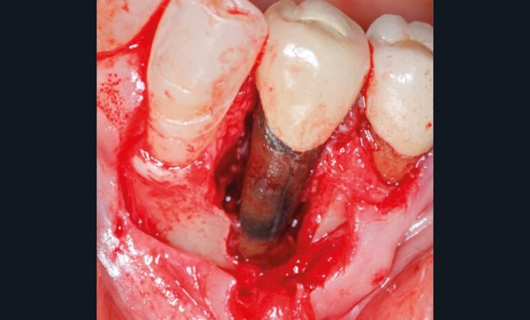 5. Lambeau d’exploration mettant en évidence une fracture radiculaire au niveau de 35.