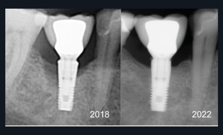2. Reconstruction osseuse spectaculaire faisant suite à un traitement par implantoplastie. Aucune décontamination n'a été réalisée. Aucun biomatériau ni aucune membrane n'ont été utilisés.