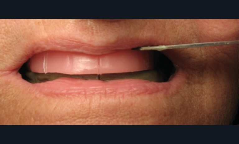 8. Marquage des déterminants esthétiques sur la maquette d’occlusion qui sont : milieu inter-incisif, pointes canines et ligne du sourire.