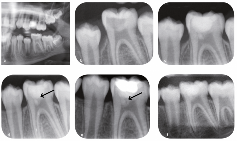 Fig. 6 - Pulpotomie partielle avec la Biodentine. Patiente de 11 ans présentant une pulpite réversible sur 36 (a-b). Après curetage de la dentine cariée, une effraction pulpaire a été observée et une pulpotomie partielle (c) a été mise en œuvre pour s’assurer de l’élimination de la pulpe inflammatoire. Le biomatériau de coiffage (Biodentine) a aussi été utilisé comme substitut dentinaire. Un composite a été réalisé lors du contrôle à deux mois. Un contrôle radiographique a été réalisé à deux mois (d) et à six mois (e). Dans ce cas particulier, le suivi radiographique de la zone péri apicale a été particulièrement difficile, du fait d’un réflexe nauséeux important empêchant la réalisation d’un bon cliché rétroalvéolaire. Un cliché panoramique de contrôle fut toutefois réalisé (f).