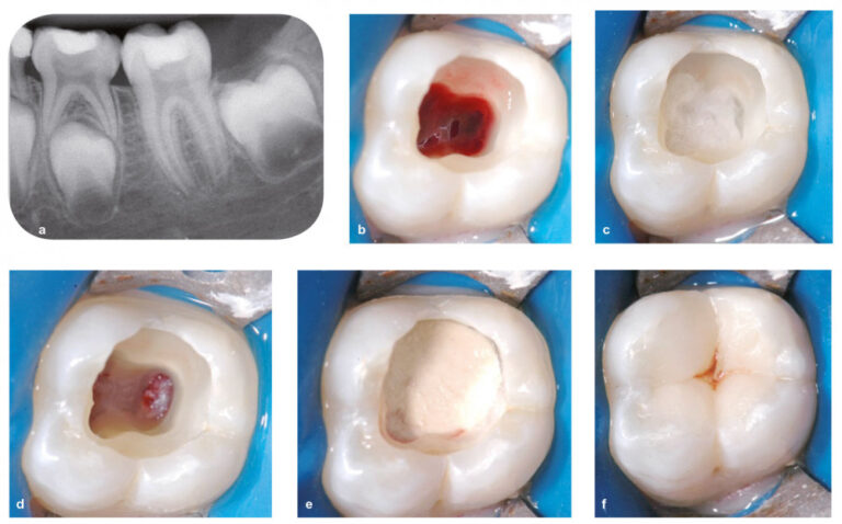 Fig. 7 - Pulpotomie camérale. Patiente de 9 ans présentant une pulpite sévère irréversible au niveau de la 36 (a). L’édification radiculaire est non terminée. Il a été décidé de mettre en œuvre une pulpotomie camérale. Après élimination de l’ancienne restauration et éviction de la dentine cariée, l’effraction pulpaire a été réalisée. Le plafond pulpaire a été éliminé ; la pulpe camérale est bien vitale et inflammatoire (b). La cavité est désinfectée et l’hémostase est recherchée à l’aide d’une boulette de coton imprégnée d’hypochlorite à 1 % (c). L’hémostase est objectivable au niveau de tous les orifices canalaires (d). Le matériau de coiffage est ensuite appliqué sur les orifices et dans la chambre pulpaire. Ici, le biomatériau Biodentine a été utilisé (e). Après la prise du biomatériau (12 minutes), dans la même séance, la restauration d’usage en résine composite a été réalisée (f). Une prescription d’antalgique (prise systématique, et non en cas de douleur, pendant 48 heures) a été faite à la fin de la séance.