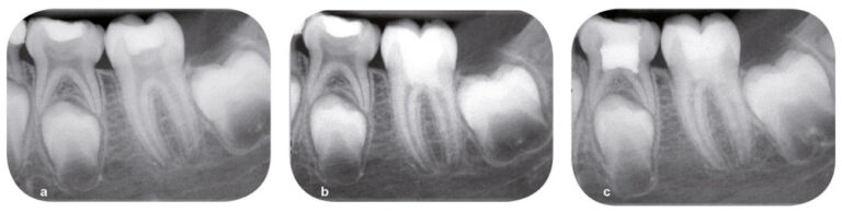 Fig. 8 - Un suivi clinique et radiographique est mis en place. La douleur a disparu dans les soixante-douze heures après la thérapeutique : radiographie préopératoire (a), radiographie postopératoire immédiate (b), radiographie après six mois (c). On objective la poursuite de l’édification radiculaire et la fermeture apicale. (Courtoisie du Dr François Bronnec)