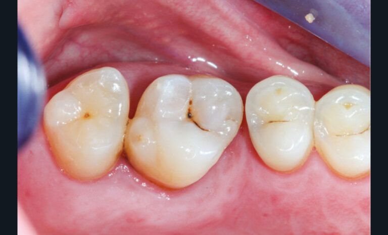 3 et 4. Photographie et radiographie de la version dentaire d’une deuxième et troisième molaires à la suite de la non-compensation de l’extraction de la première ; des caries proximales sont détectables uniquement à la radiographie.