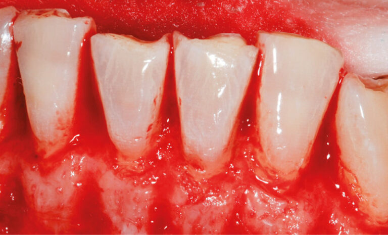 3b. Gingivectomie associée à une ostectomie limitée de 1 à 2 mm en vestibulaire pour recréer l’espace de l’attache supra-crestale.