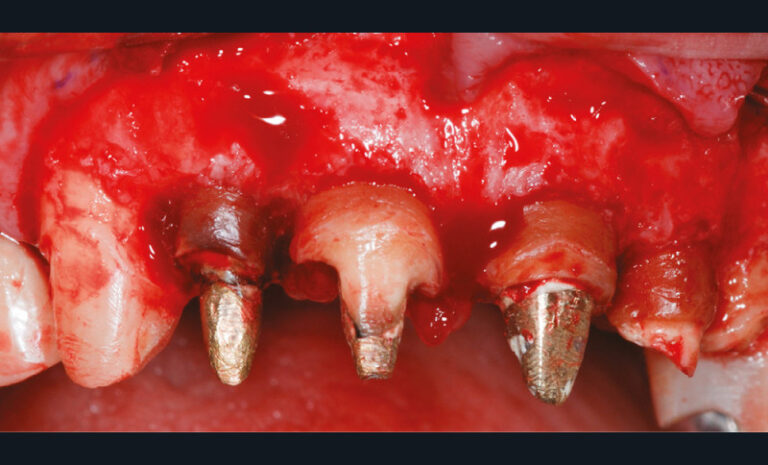4b. Gingivectomie associée à une ostectomie circonférentielle de 3 à 5 mm afin de recréer l’espace de l’attache supra-crestale et de la structure dentaire disponible pour la rétention prothétique.