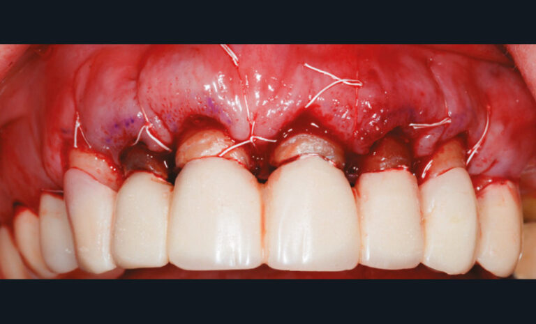 4c. Lambeau repositionné et suturé en fin d’intervention. Le bridge provisoire est rescellé. 2 mm de dentine saine émergent de la gencive marginale pour le futur sertissage prothétique.