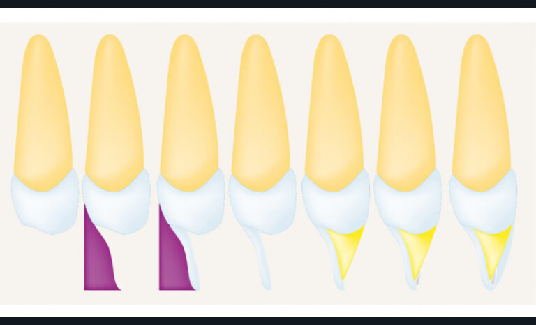 17 et 18. Schéma didactique des étapes de la stratification naturelle. De gauche à droite : - situation initiale ; - mise en place de la clé en silicone pour s’assurer de son bon positionnement ; - réalisation du mur palatin de la restauration avec du composite émail ; - retrait de la clé en silicone ; - recréation des lobes de dentine par une masse dentine appliquée sur le mur palatin ; - ajout de masses effets pour caractériser une dent ; - recouvrement total par la masse émail sélectionnée des lobes dentinaires préalablement reconstitués.
