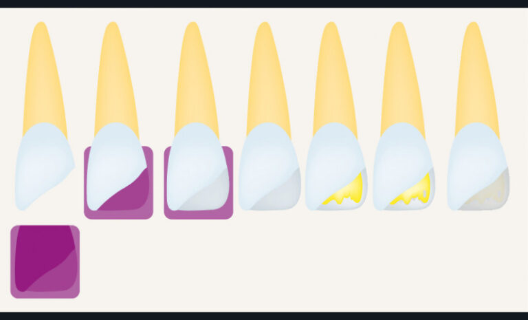 17 et 18. Schéma didactique des étapes de la stratification naturelle. De gauche à droite : - situation initiale ; - mise en place de la clé en silicone pour s’assurer de son bon positionnement ; - réalisation du mur palatin de la restauration avec du composite émail ; - retrait de la clé en silicone ; - recréation des lobes de dentine par une masse dentine appliquée sur le mur palatin ; - ajout de masses effets pour caractériser une dent ; - recouvrement total par la masse émail sélectionnée des lobes dentinaires préalablement reconstitués.
