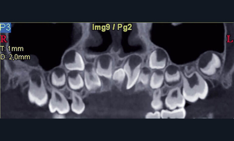 Fig. 10
a) Cas clinique 3. Reconstruction curviligne de type panoramique identifiant un odontome de type mesiodens entre 11 et 21 (appareil CBCT NewTom® 5g, Quantitative Radiology®) chez un enfant de 6 ans.