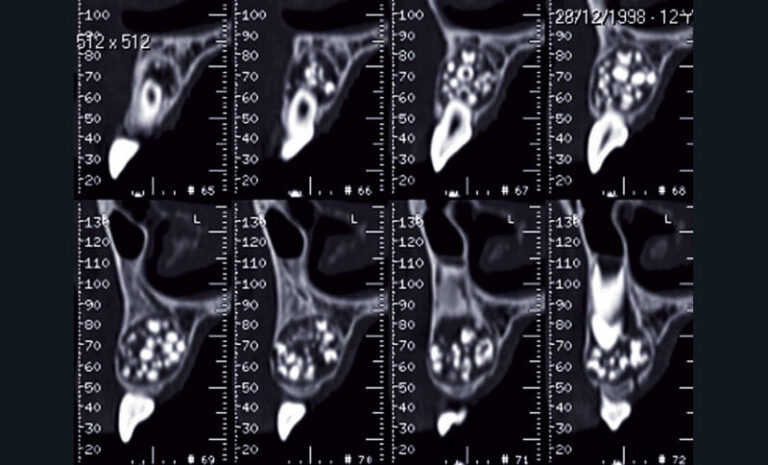 Fig. 11
a) Cas clinique 4. Reconstructions coronales identifiant la présence d’un odontome complexe dans la région maxillaire antérieure chez une adolescente de 12 ans (Dentascanner, appareil de tomodensitométrie GE HealthCare®).