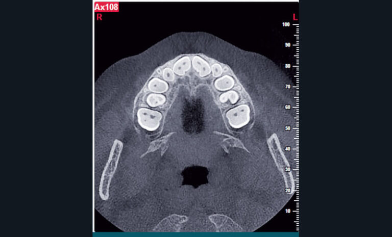 Fig.13
a) Cas clinique 5. Reconstruction axiale identifiant 2 incisives permanentes maxillaires avec des morphologies coronaires (fusions de 11 et 12, et de 21 et 22) et canalaires (2 canaux parfaitement individualisés) atypiques chez un enfant de 5 ans (NewTom® 5g, Quantitative Radiology®).