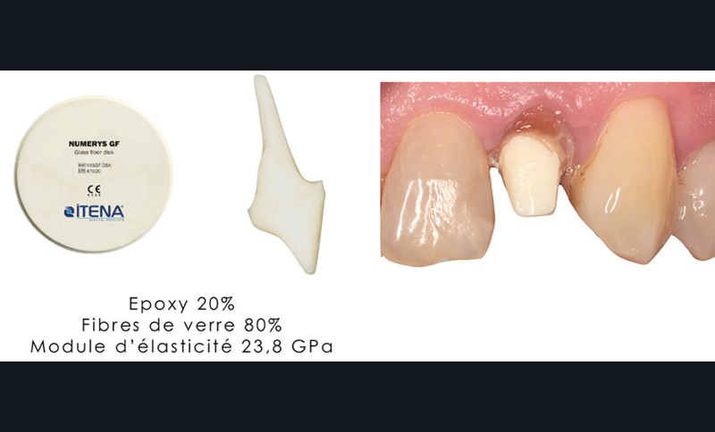 3. Bloc Numerys GF utilisé pour l’usinage d’inlay-core fibré.