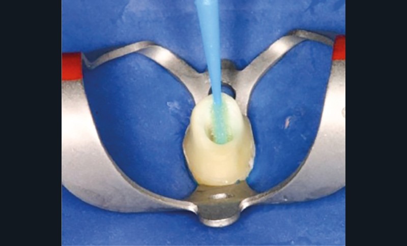 7. Application de l’adhésif intracanalaire.