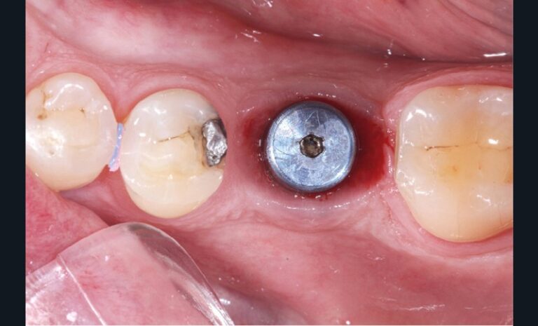 4. Vue clinique après l’empreinte, une vis de cicatrisation protège l’implant.