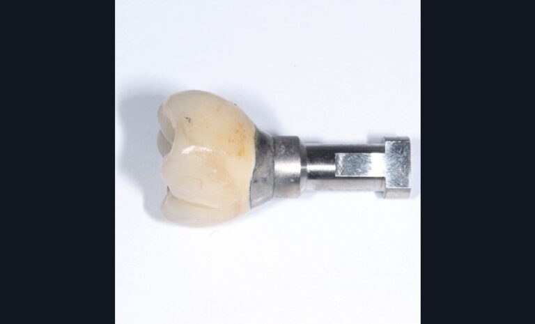 5. Connexion de la prothèse à un analogue pour faciliter la manipulation au laboratoire.