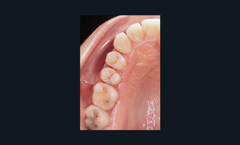 3b. Stripping de 0,5 mm.