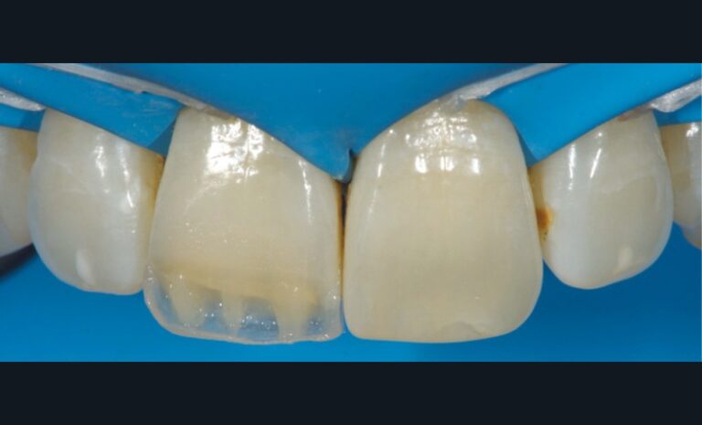i. Les fusées dentinaires de part et d’autre de la crête médiane des lobes sont rehaussées par une résine composite (Dark Dentin).