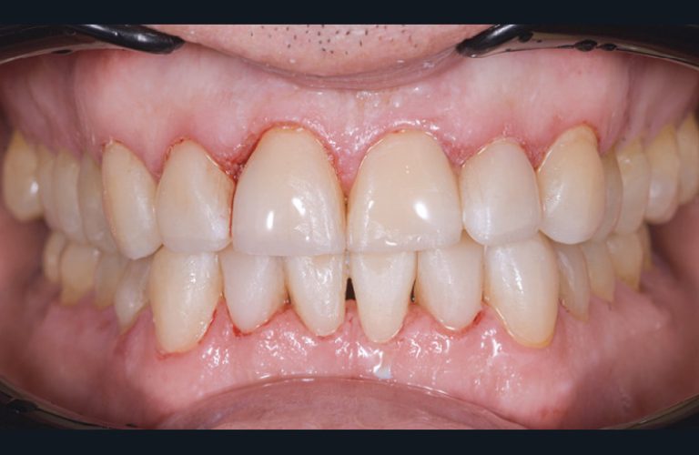 9. Composites injectés au terme de la séance de soins. a, b. Vues de face en occlusion et en bout à bout.