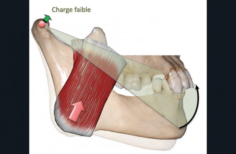 9. Perte de calage postérieur et antérieur = perte de DVO. Dans la perte de DVO, il existe toujours une perte de calage occlusal postérieur associée à une perte de calage occlusal antérieur. Le centre de rotation est condylien ➞ absence de surcharge de l’ATM.