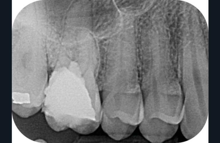 Radiographies pré, per et post-opératoire du traitement endodontique de 16 avec l’obturation de la perforation par un CHSC (pointillés roses) (b)