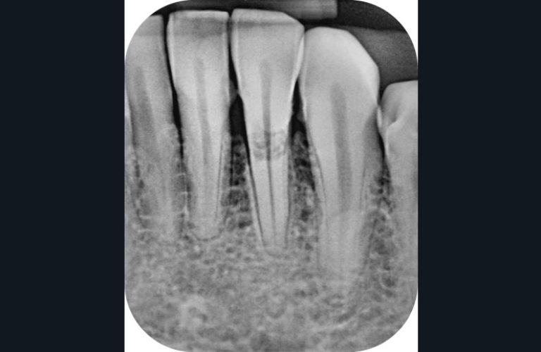 9. Approche combinée de la gestion d’une résorption cervicale externe. Radiographie rétroalvéolaire pré-opératoire (a)