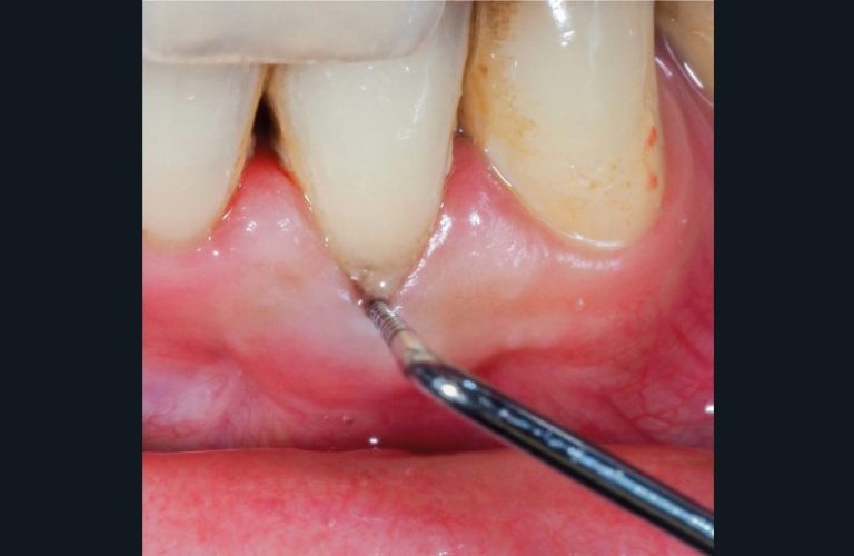 Vue clinique avec mise en évidence de la résorption (c)