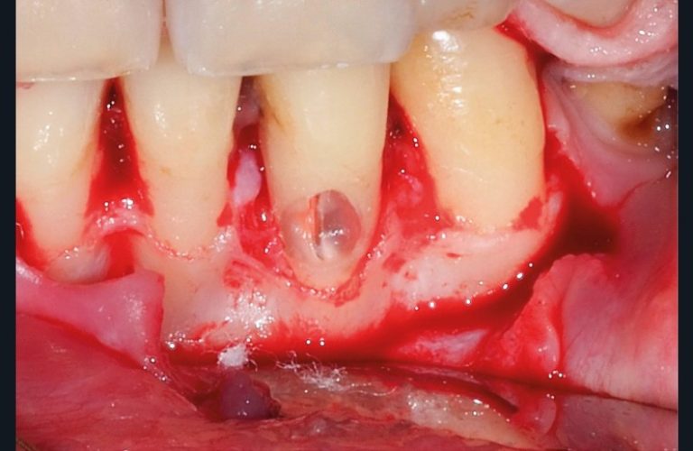 Le traitement endodontique est débuté et un cône de gutta percha est mis en place dans le canal afin de le protéger (d)