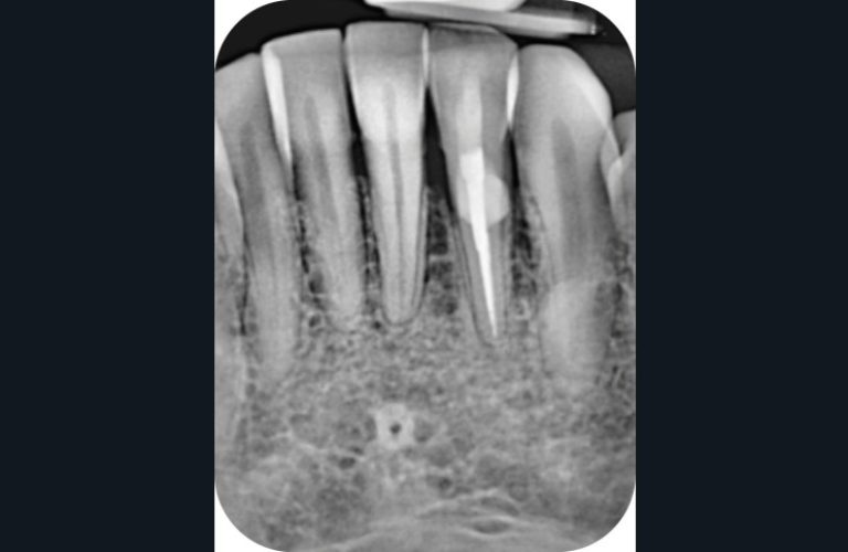 Radiographie de contrôle réalisé à un an post-opératoire (f)