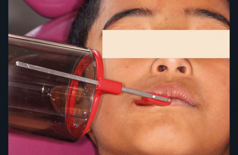 Fig. 6
a) Cas clinique 1. Orientation du cône radiogène et utilisation d’un porte-récepteur pour réaliser des clichés rétro-coronaires chez un enfant de 7 ans. L’angulation est de 15° par rapport au plan horizontal.
Des clichés rétro-alvéolaires sélectifs seront réalisés ensuite (lésions carieuses profondes).