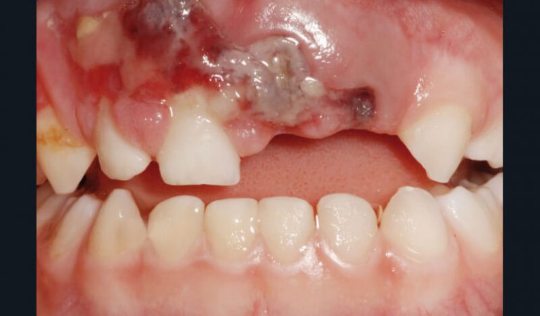 Fig. 7
a) Cas clinique 2. Vue clinique d’un traumatisme dento-alvéolaire (expulsion de 61, 62, luxation latérale de 51) survenu suite à une chute chez un enfant de 4 ans.